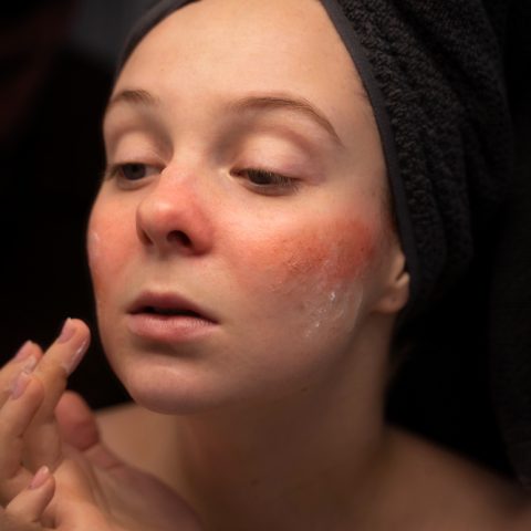 woman rosacea