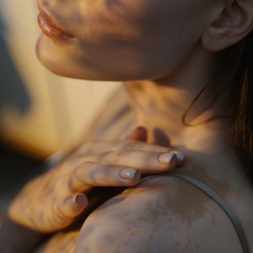 pexels-ron-lach-vitiligo
